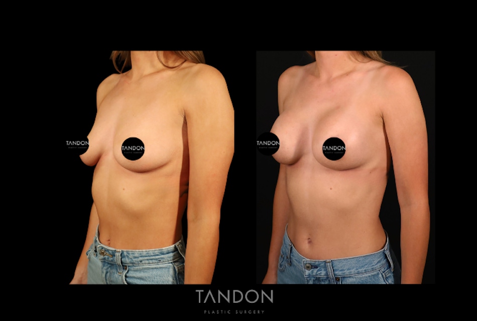 Preservé by Motiva Breast Augmentation Before & After Gallery - Patient 270312 - Image 5