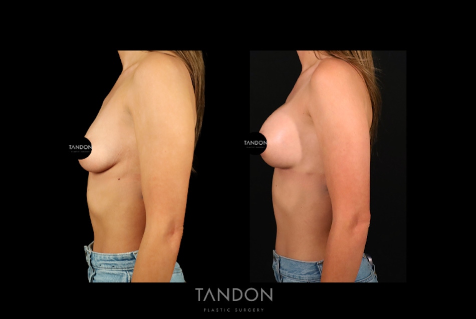 Preservé by Motiva Breast Augmentation Before & After Gallery - Patient 270312 - Image 4