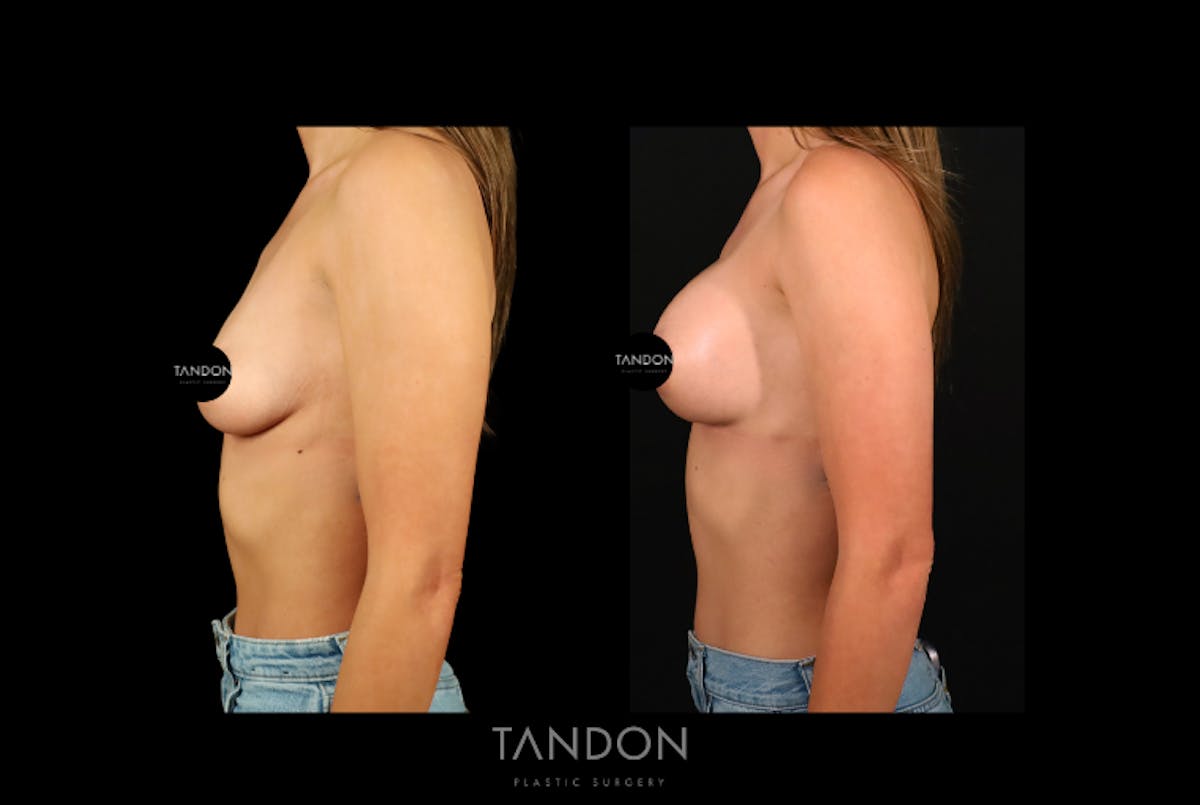 Breast Augmentation  Before & After Gallery - Patient 217753 - Image 4