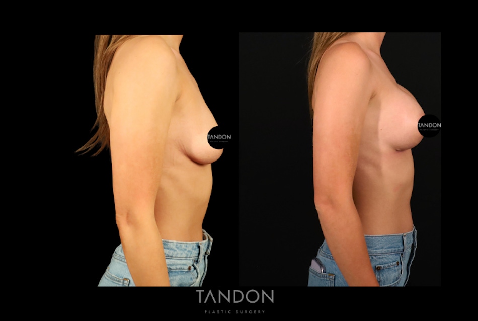 Preservé by Motiva Breast Augmentation Before & After Gallery - Patient 270312 - Image 3