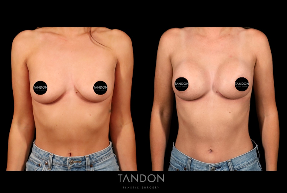 Preservé by Motiva Breast Augmentation Before & After Gallery - Patient 270312 - Image 1