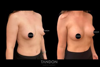 Preservé by Motiva Breast Augmentation Before & After Gallery - Patient 216430 - Image 4