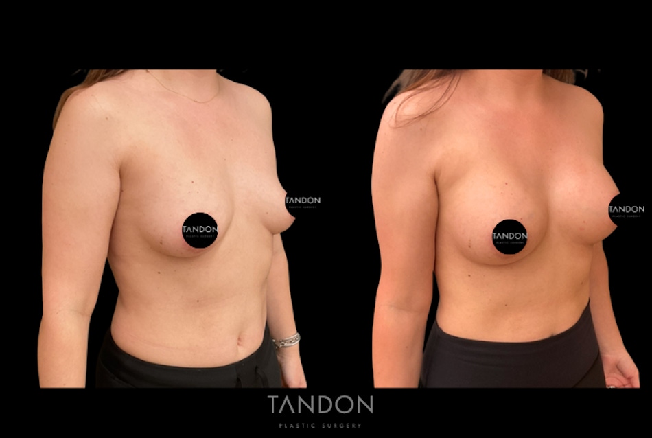 Preservé by Motiva Breast Augmentation Before & After Gallery - Patient 216430 - Image 4