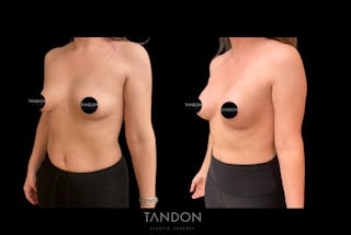 Preservé by Motiva Breast Augmentation Before & After Gallery - Patient 216430 - Image 2