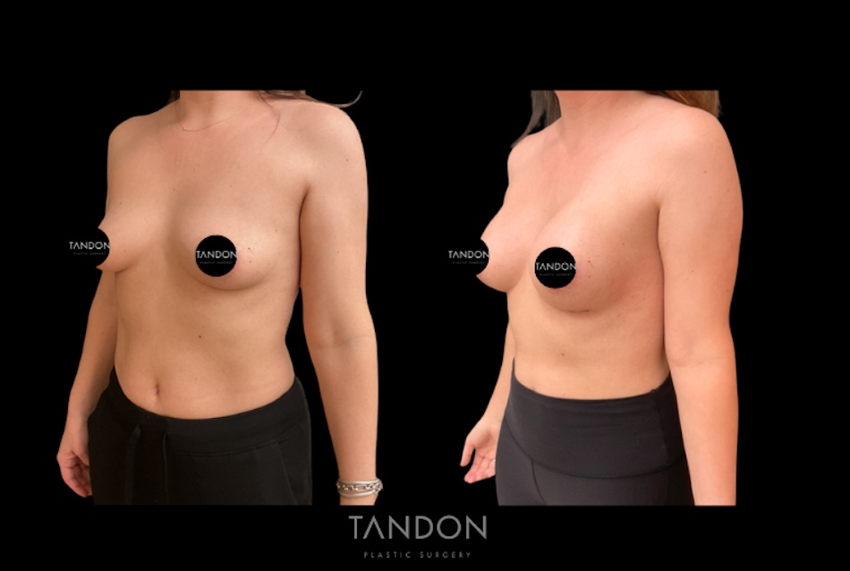 Preservé by Motiva Breast Augmentation Before & After Gallery - Patient 216430 - Image 2