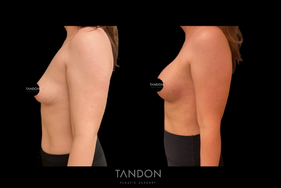 Preservé by Motiva Breast Augmentation Before & After Gallery - Patient 216430 - Image 3