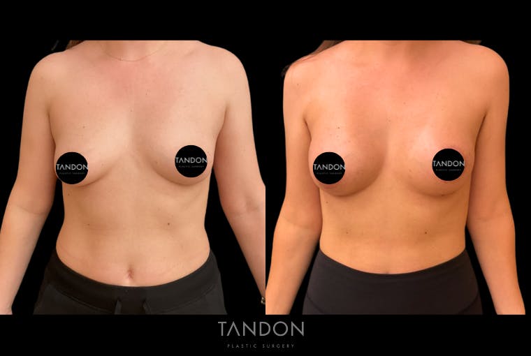 Preservé by Motiva Breast Augmentation Before & After Gallery - Patient 216430 - Image 1
