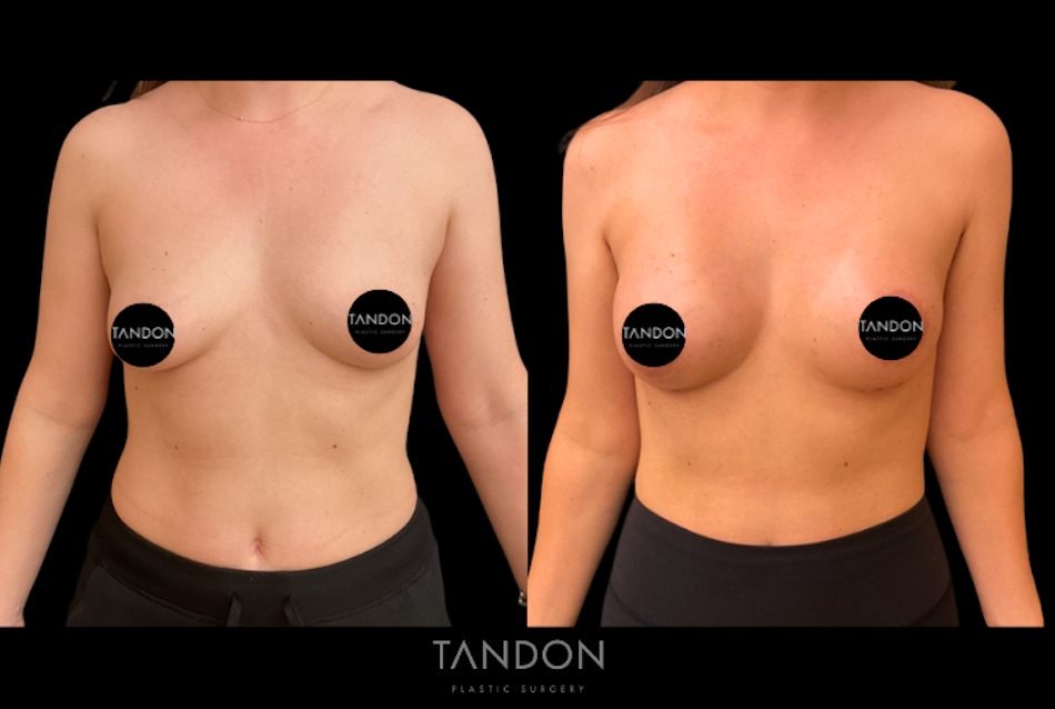 Preservé by Motiva Breast Augmentation Before & After Gallery - Patient 216430 - Image 1
