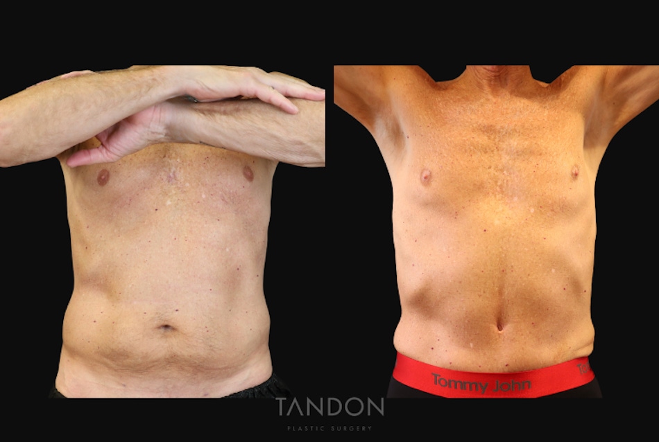 Male Abdominoplasty Before & After Gallery - Patient 754782 - Image 1