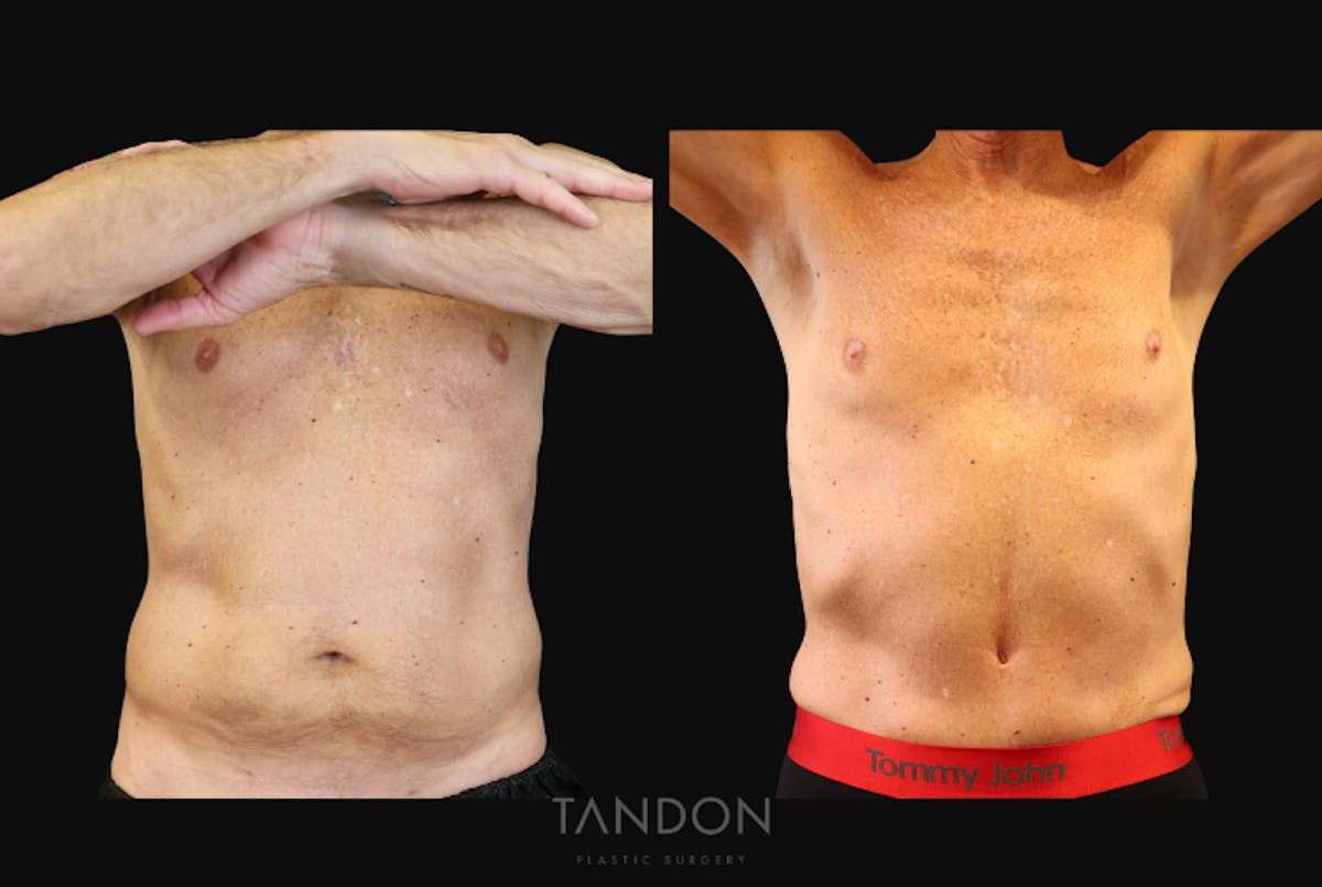 Male Abdominoplasty Before & After Gallery - Patient 754782 - Image 1