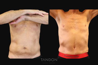 Abdominoplasty (Tummy Tuck) Before & After Gallery - Patient 410114 - Image 1