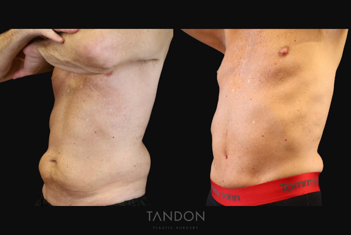 Male Abdominoplasty Before & After Gallery - Patient 754782 - Image 5