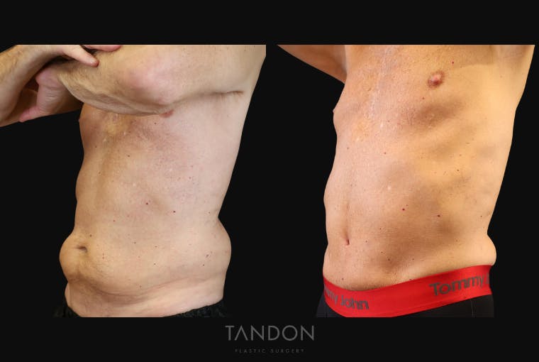 Abdominoplasty (Tummy Tuck) Before & After Gallery - Patient 410114 - Image 5