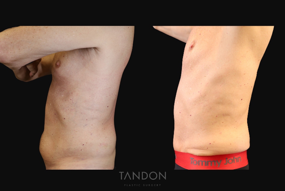 Male Abdominoplasty Before & After Gallery - Patient 754782 - Image 4