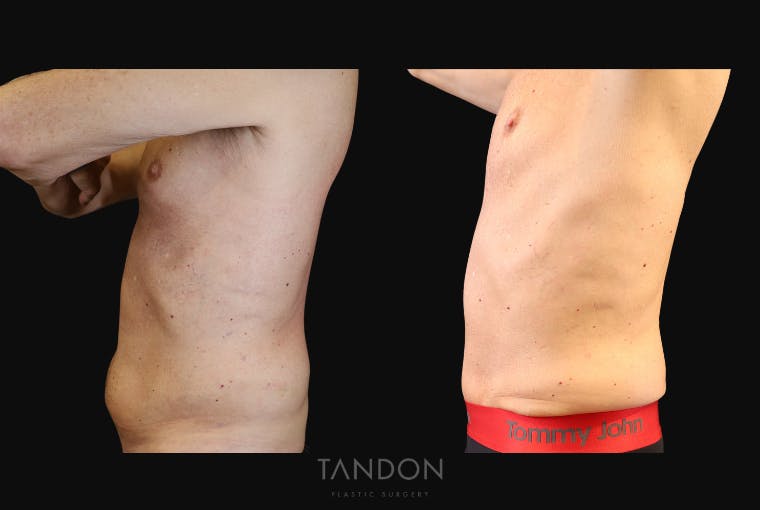 Abdominoplasty (Tummy Tuck) Before & After Gallery - Patient 410114 - Image 4