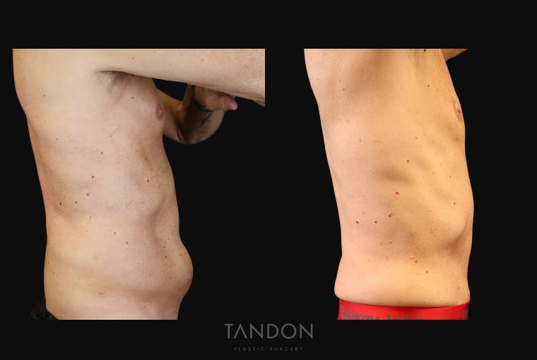Abdominoplasty (Tummy Tuck) Before & After Gallery - Patient 410114 - Image 3