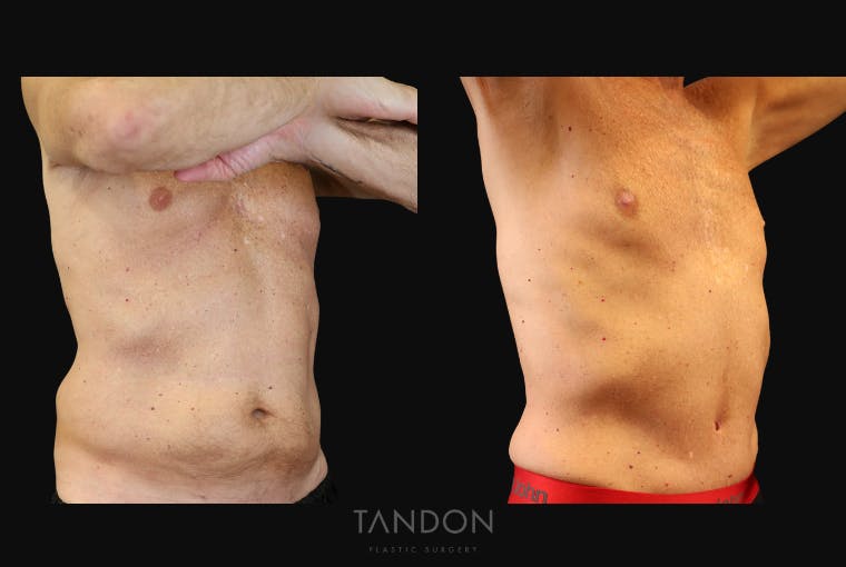 Abdominoplasty (Tummy Tuck) Before & After Gallery - Patient 410114 - Image 2