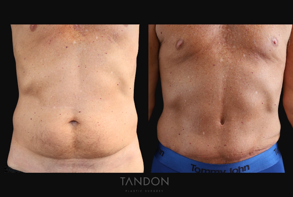 Abdominoplasty (Tummy Tuck) Before & After Gallery - Patient 166861 - Image 1