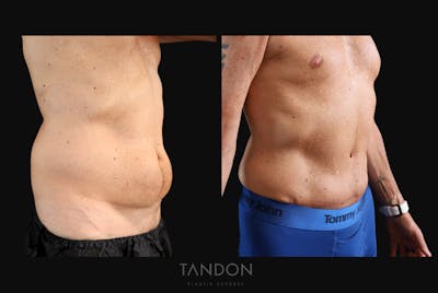 Abdominoplasty (Tummy Tuck) Before & After Gallery - Patient 166861 - Image 2