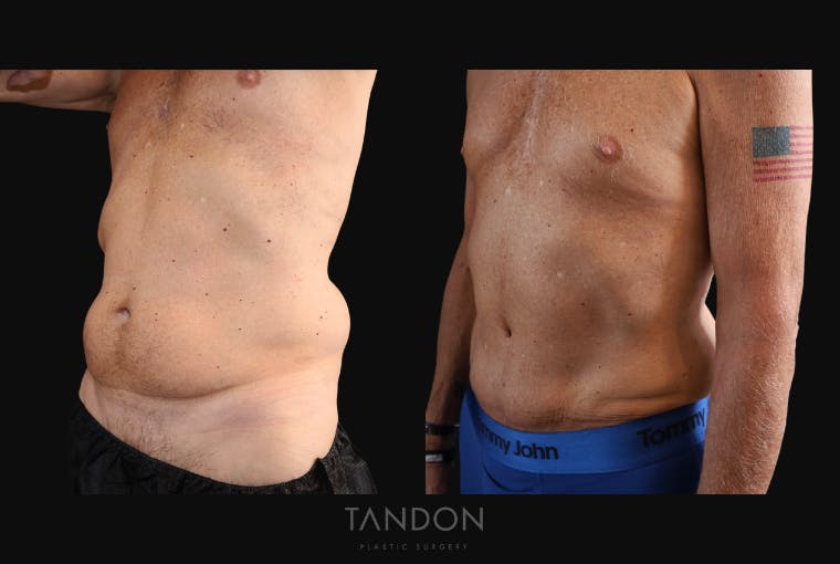 Abdominoplasty (Tummy Tuck) Before & After Gallery - Patient 166861 - Image 5
