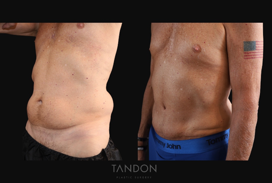 Abdominoplasty (Tummy Tuck) Before & After Gallery - Patient 166861 - Image 5