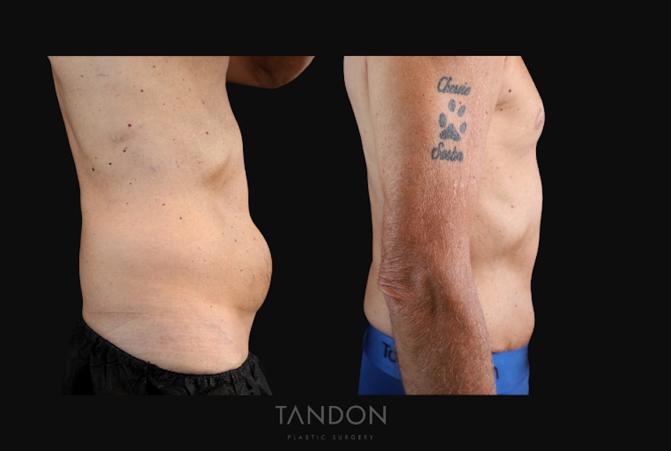 Abdominoplasty (Tummy Tuck) Before & After Gallery - Patient 166861 - Image 3