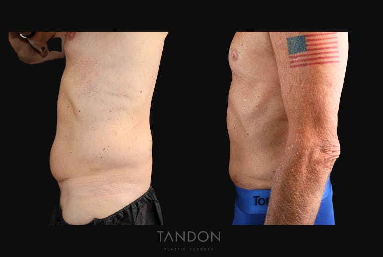 Abdominoplasty (Tummy Tuck) Before & After Gallery - Patient 166861 - Image 4