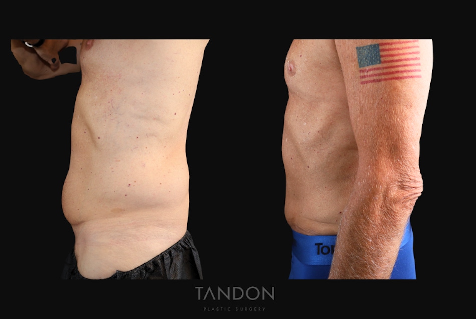 Abdominoplasty (Tummy Tuck) Before & After Gallery - Patient 166861 - Image 4