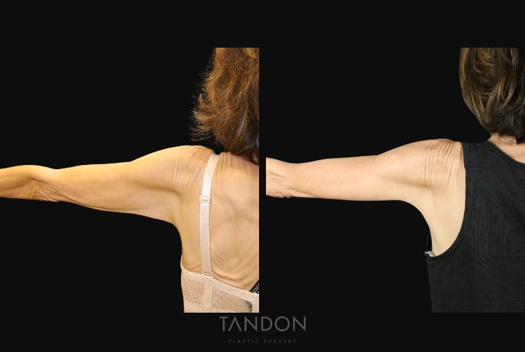 Arm Lift (Brachioplasty) Before & After Gallery - Patient 250473 - Image 4
