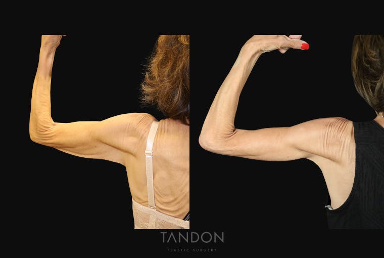 Arm Lift (Brachioplasty) Before & After Gallery - Patient 250473 - Image 5