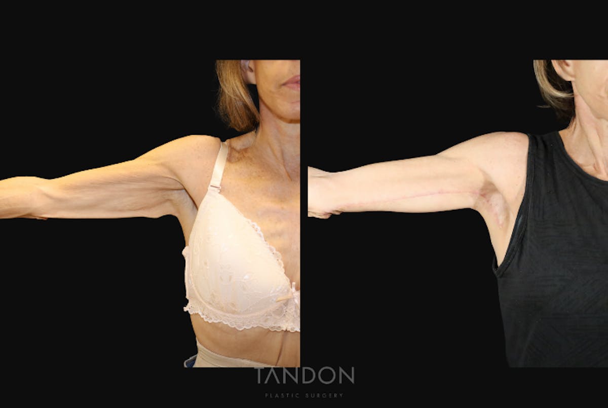 Arm Lift (Brachioplasty) Before & After Gallery - Patient 250473 - Image 3