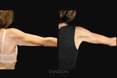 Arm Lift (Brachioplasty) Before & After Gallery - Patient 250473 - Image 1