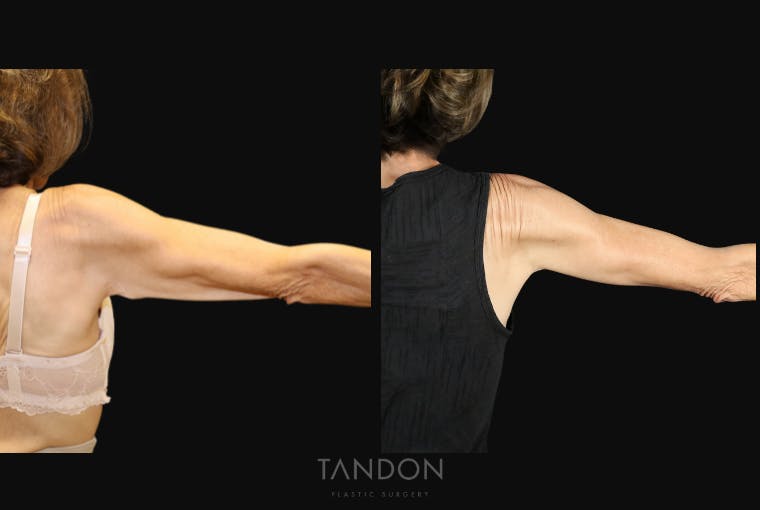 Arm Lift (Brachioplasty) Before & After Gallery - Patient 250473 - Image 1