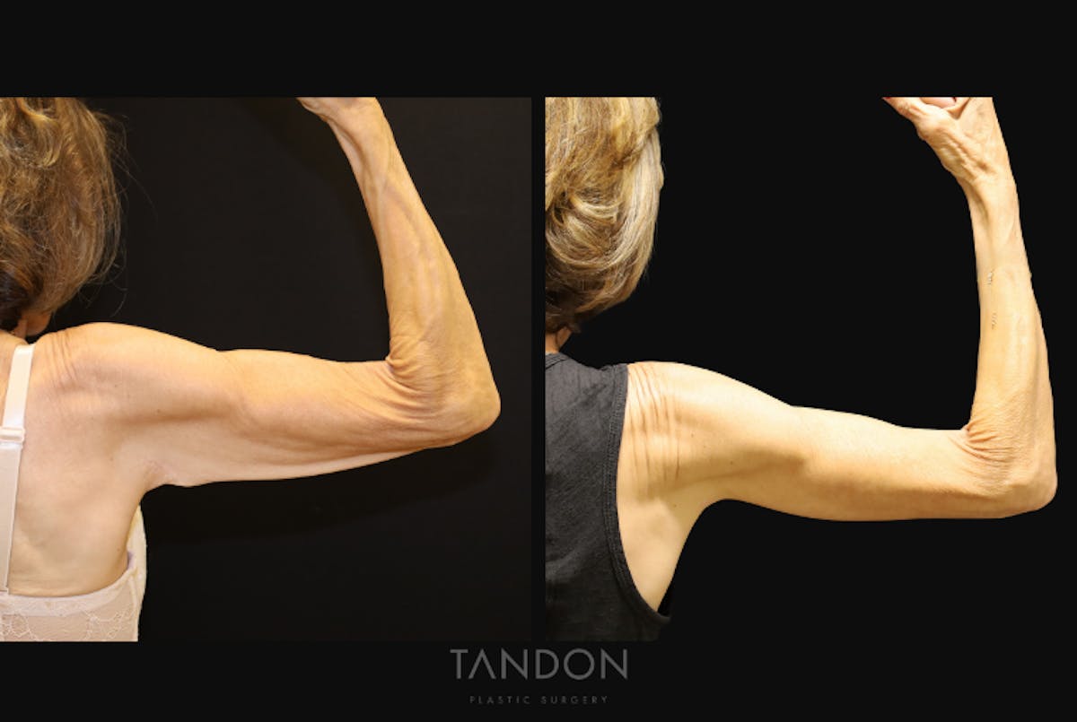 Arm Lift (Brachioplasty) Before & After Gallery - Patient 250473 - Image 2