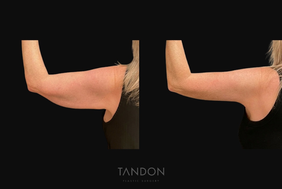 Arm Lift (Brachioplasty) Before & After Gallery - Patient 394814 - Image 3