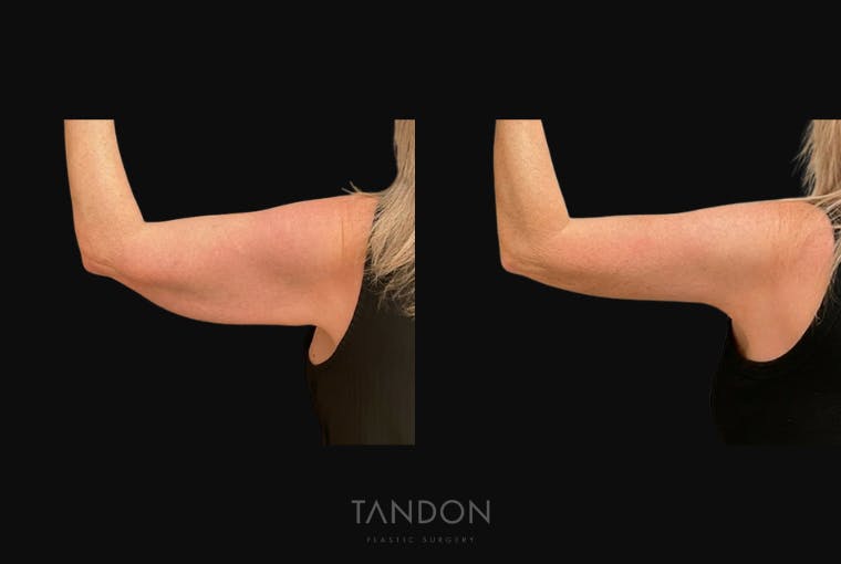 Arm Lift (Brachioplasty) Before & After Gallery - Patient 394814 - Image 3