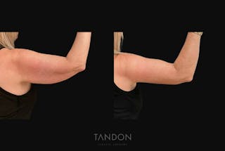 Arm Lift (Brachioplasty) Before & After Gallery - Patient 394814 - Image 2