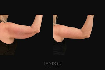 Arm Lift (Brachioplasty) Before & After Gallery - Patient 394814 - Image 2