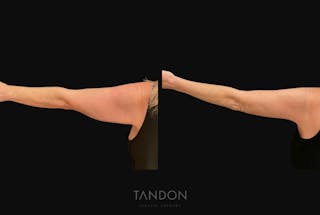 Arm Lift (Brachioplasty) Before & After Gallery - Patient 394814 - Image 4