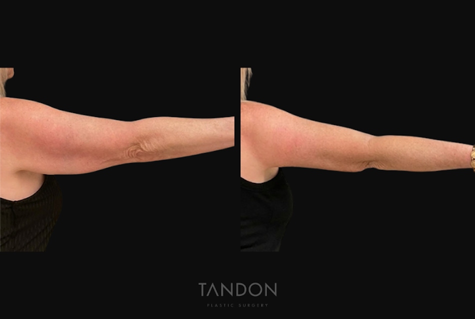Arm Lift (Brachioplasty) Before & After Gallery - Patient 394814 - Image 1