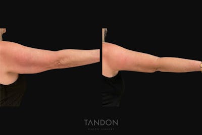 Arm Lift (Brachioplasty) Before & After Gallery - Patient 394814 - Image 1