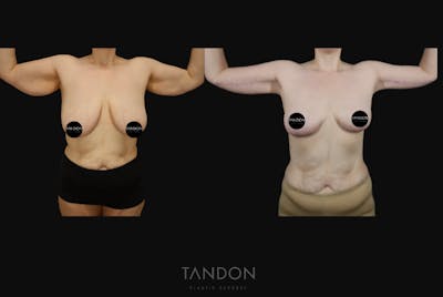 Arm Lift (Brachioplasty) Before & After Gallery - Patient 533021 - Image 2