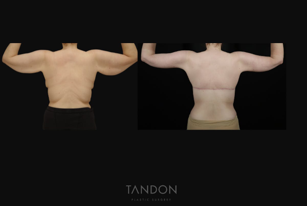 Arm Lift (Brachioplasty) Before & After Gallery - Patient 533021 - Image 1