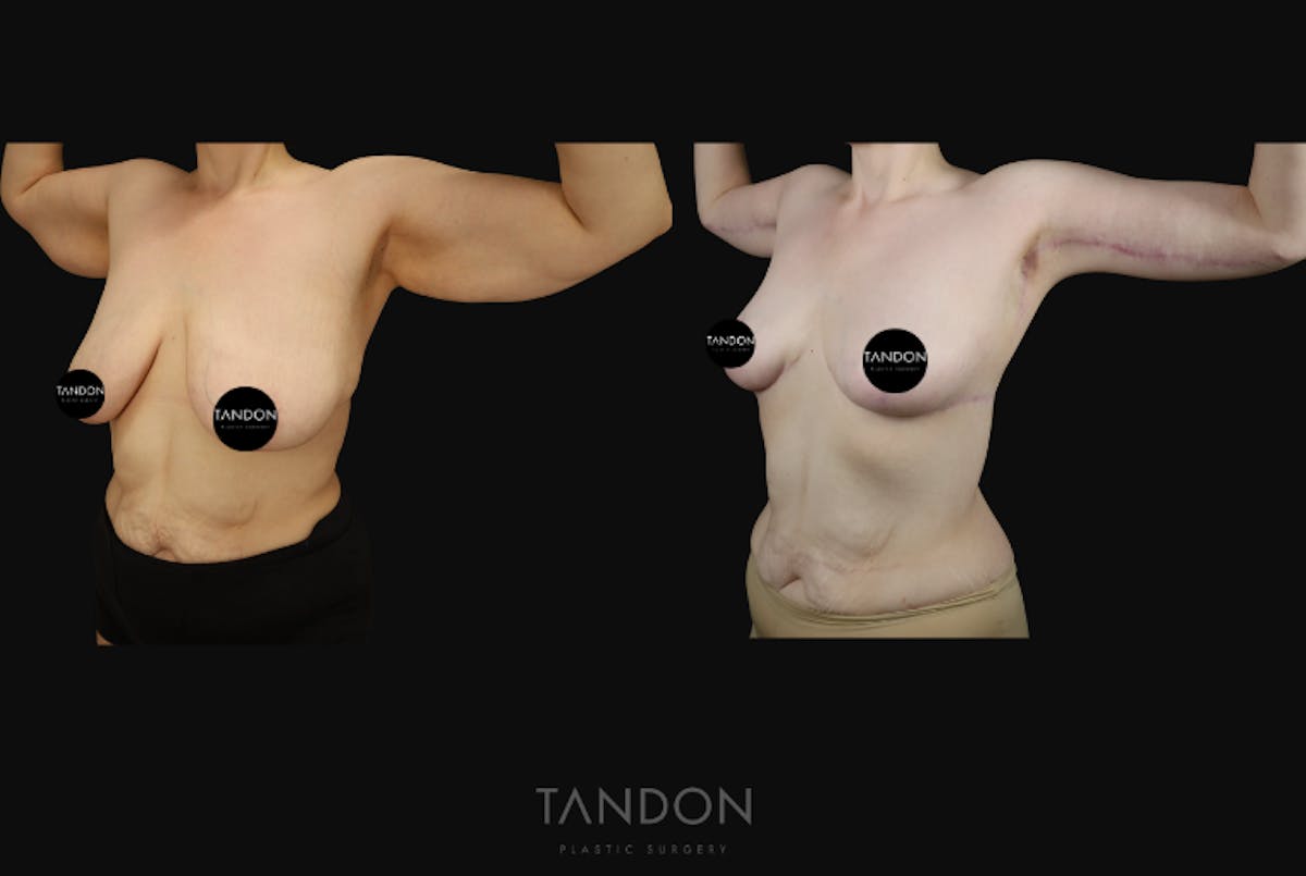 Arm Lift (Brachioplasty) Before & After Gallery - Patient 533021 - Image 3