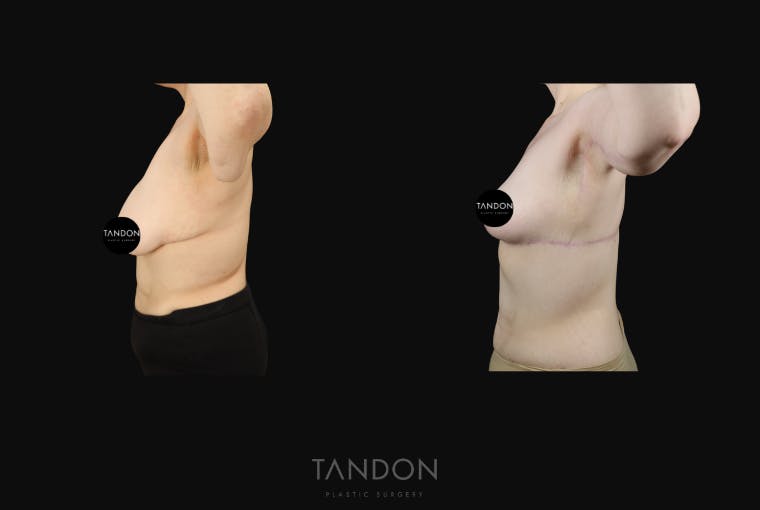 Arm Lift (Brachioplasty) Before & After Gallery - Patient 533021 - Image 6