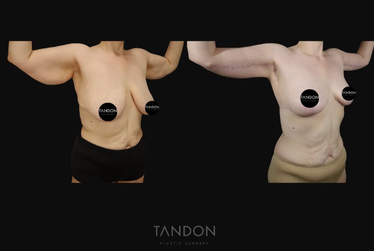 Arm Lift (Brachioplasty) Before & After Gallery - Patient 533021 - Image 4
