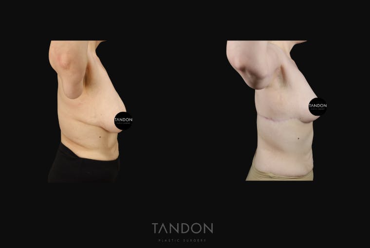 Arm Lift (Brachioplasty) Before & After Gallery - Patient 533021 - Image 5