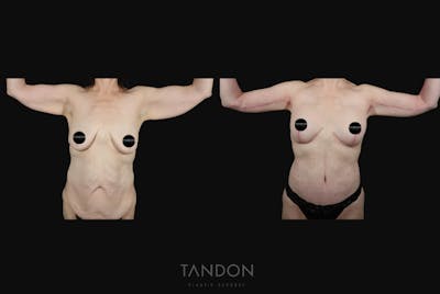 Arm Lift (Brachioplasty) Before & After Gallery - Patient 340609 - Image 1