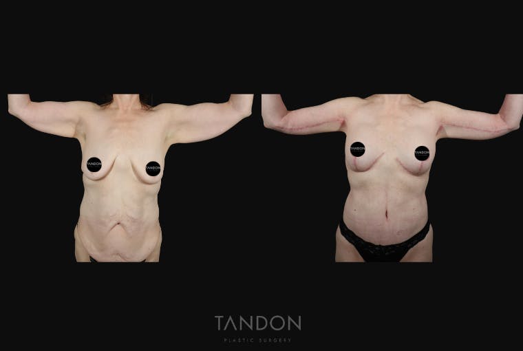 Arm Lift (Brachioplasty) Before & After Gallery - Patient 340609 - Image 1