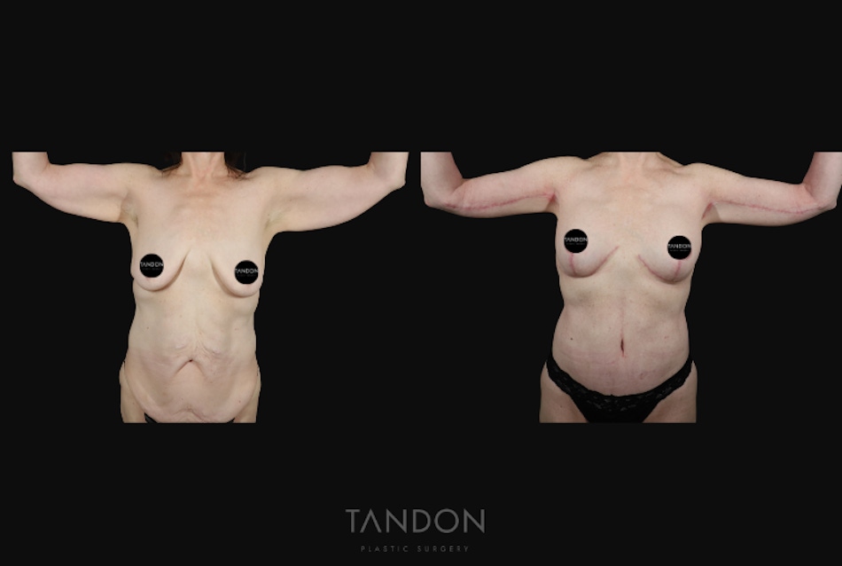 Arm Lift (Brachioplasty) Before & After Gallery - Patient 340609 - Image 1